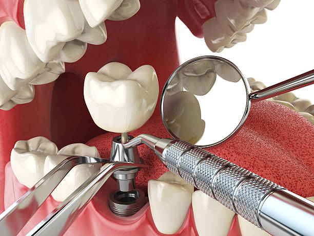 Best Emergency Dentist for Lost Fillings or Crowns in Nogales, AZ